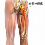 坐骨神経痛との関連画像