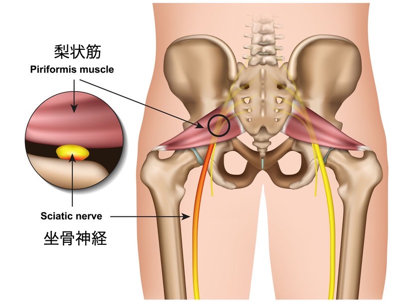 梨状筋症候群画像