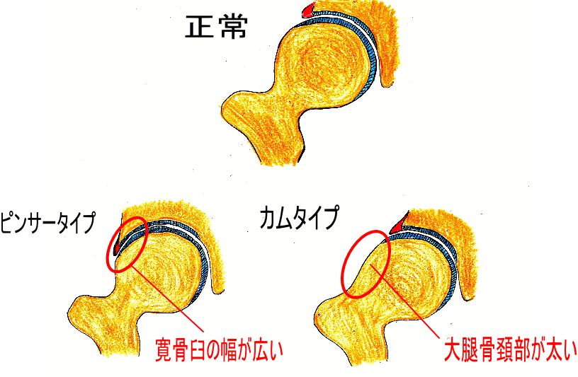 股関節インピンジメント画像