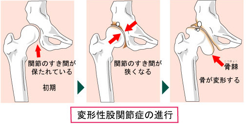 変形性股関節症画像